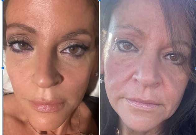 Dramatic Facial Rejuvenation Before and After - Advanced Skin Treatment